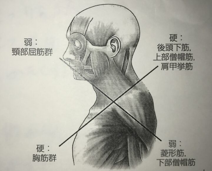 肩のインピンジメント症候群と胸郭の画像